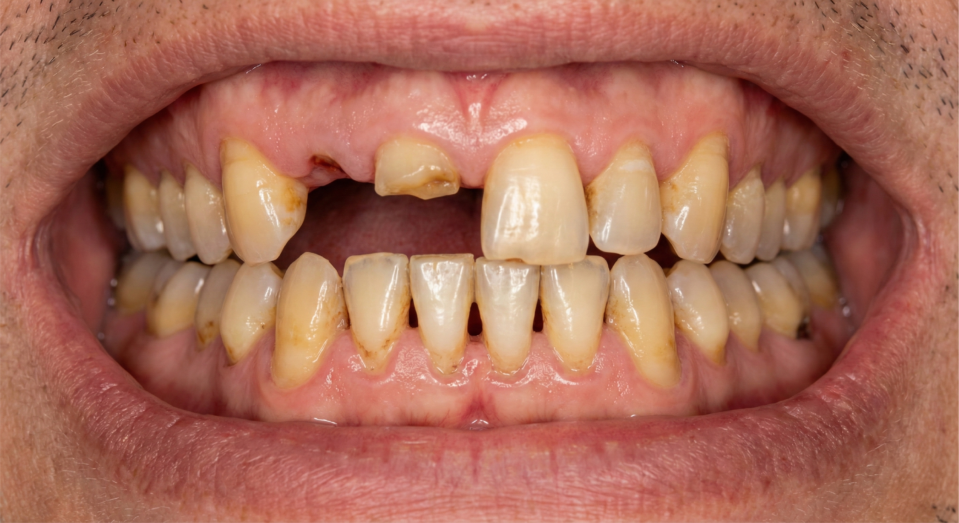 Before — Full Mouth Rehabilitation